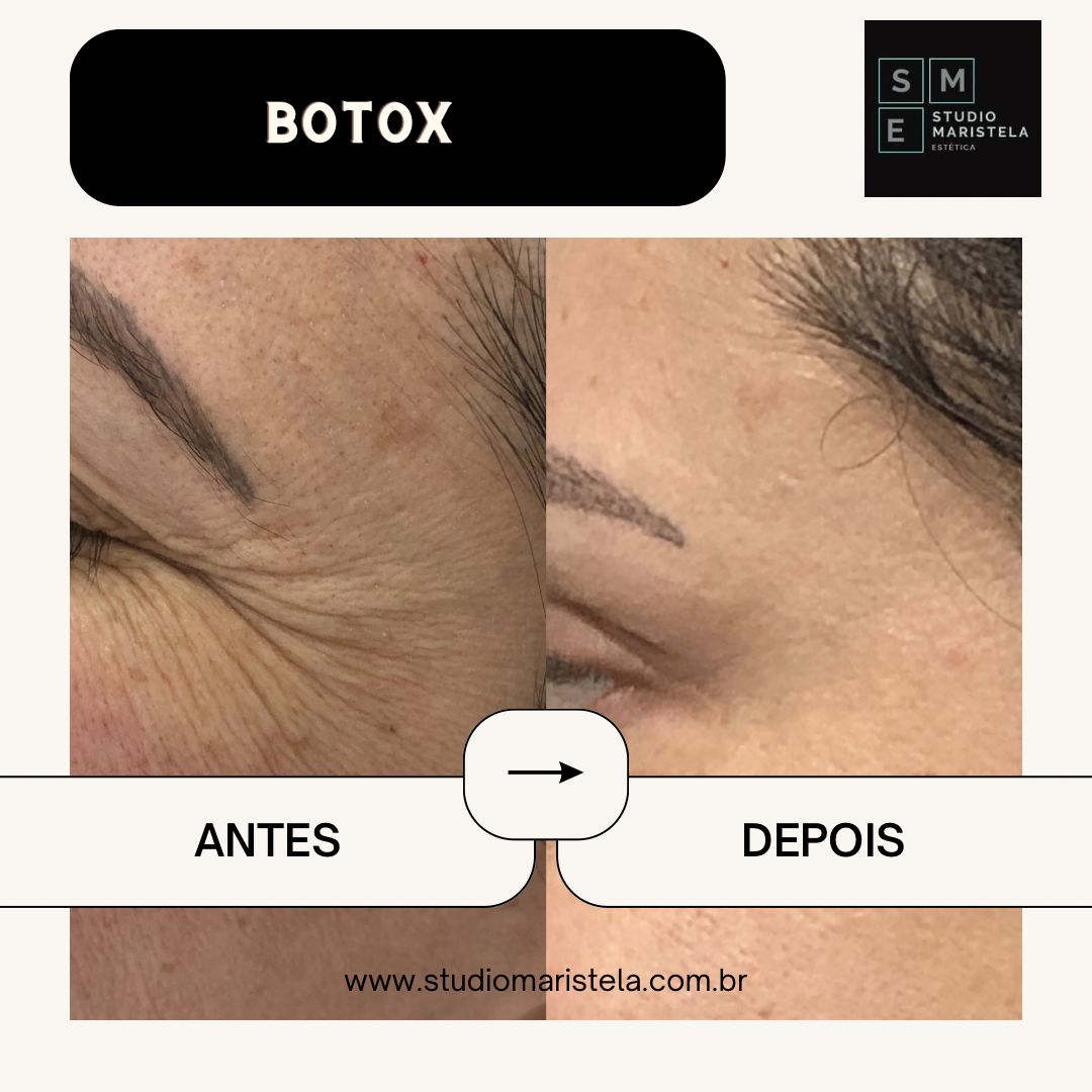 Botox O Ano Todo – Assinatura Anual – Com Retorno Incluso - Imagem 4
