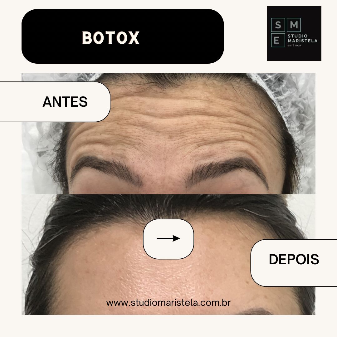 Botox O Ano Todo – Assinatura Anual – Com Retorno Incluso - Imagem 3