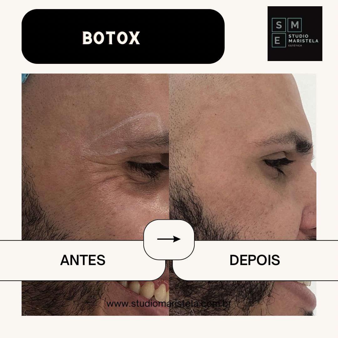 Botox O Ano Todo – Assinatura Anual – Com Retorno Incluso - Imagem 2